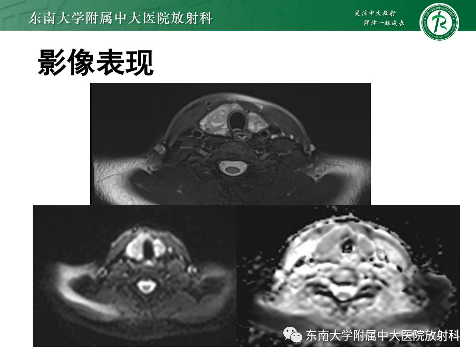 影像PPT - 【PPT】甲状腺癌的影像诊断-29