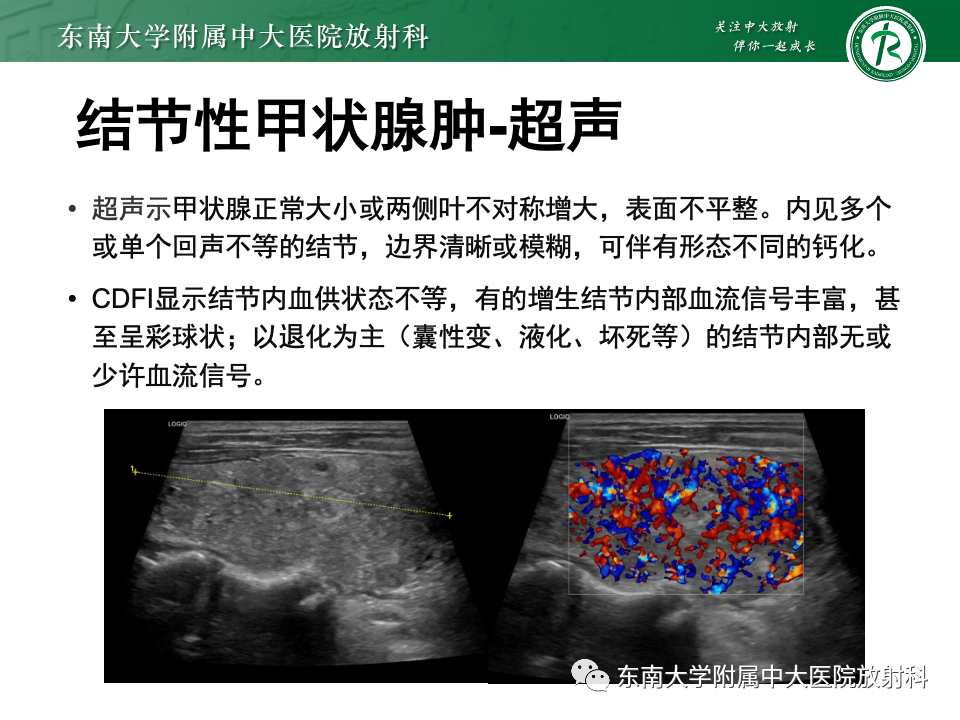影像PPT - 【PPT】甲状腺癌的影像诊断-32