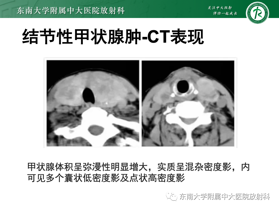 影像PPT - 【PPT】甲状腺癌的影像诊断-34