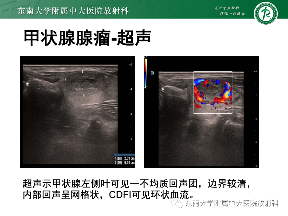 影像PPT - 【PPT】甲状腺癌的影像诊断-37