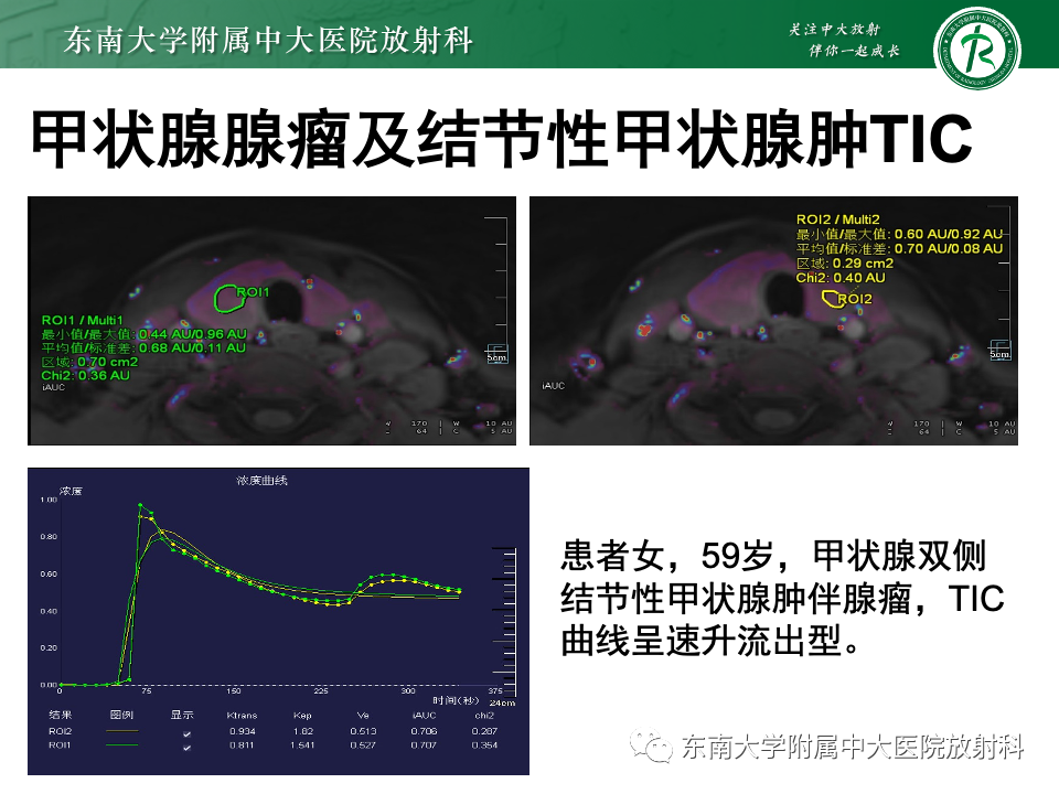 影像PPT - 【PPT】甲状腺癌的影像诊断-39