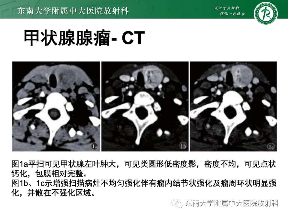 影像PPT - 【PPT】甲状腺癌的影像诊断-38