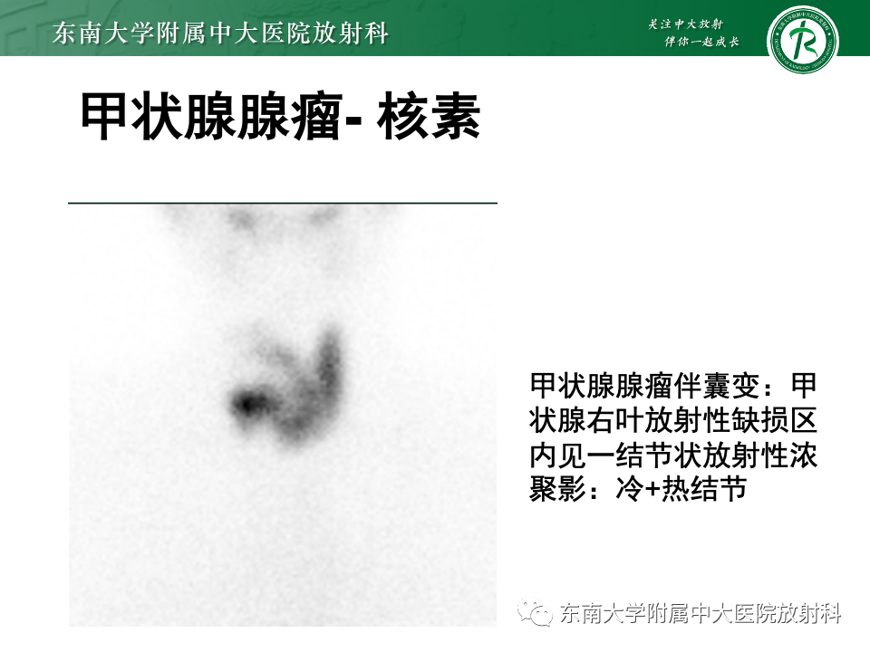 影像PPT - 【PPT】甲状腺癌的影像诊断-40