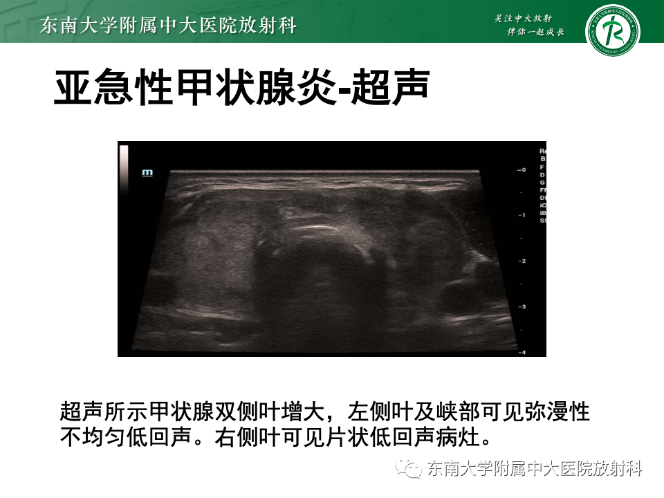 影像PPT - 【PPT】甲状腺癌的影像诊断-43