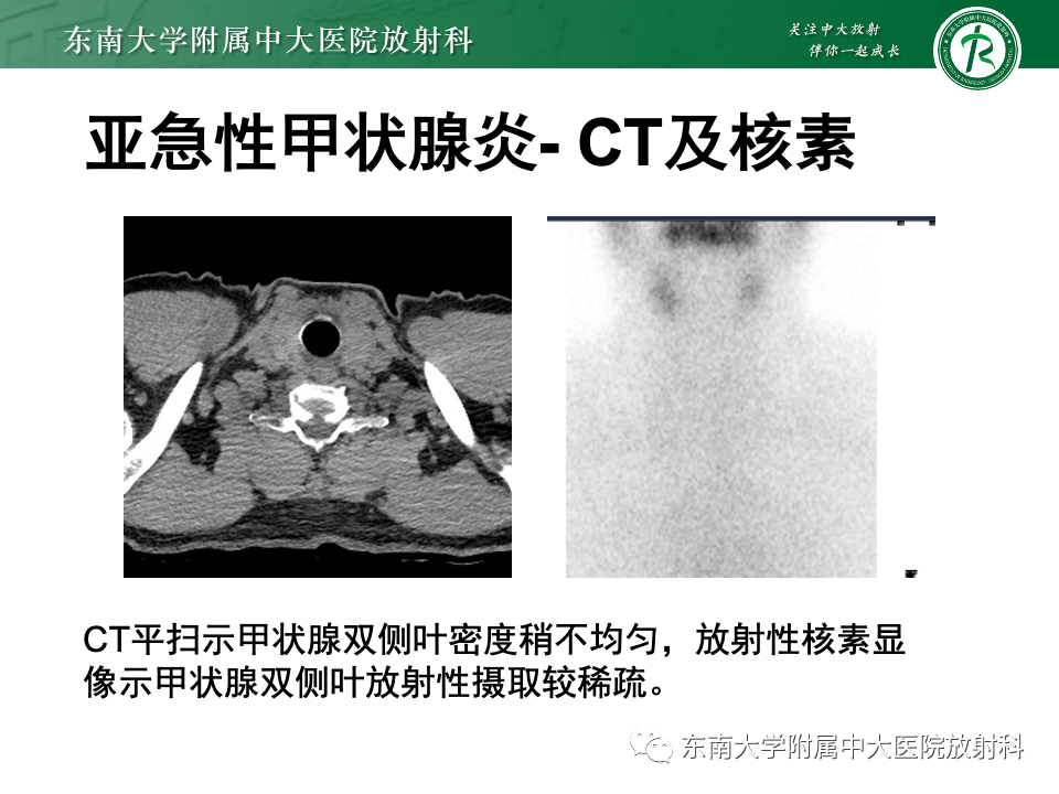 影像PPT - 【PPT】甲状腺癌的影像诊断-44