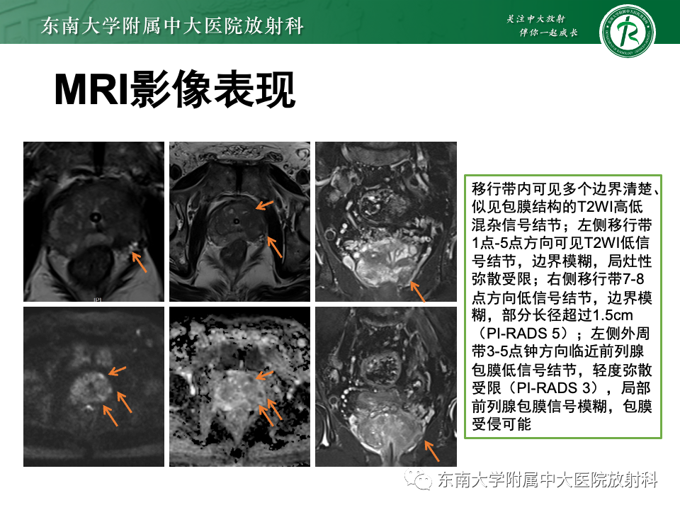 影像PPT - 【PPT】理影外合——前列腺癌-10 影像PPT - 【PPT】理影外合——前列腺癌-10