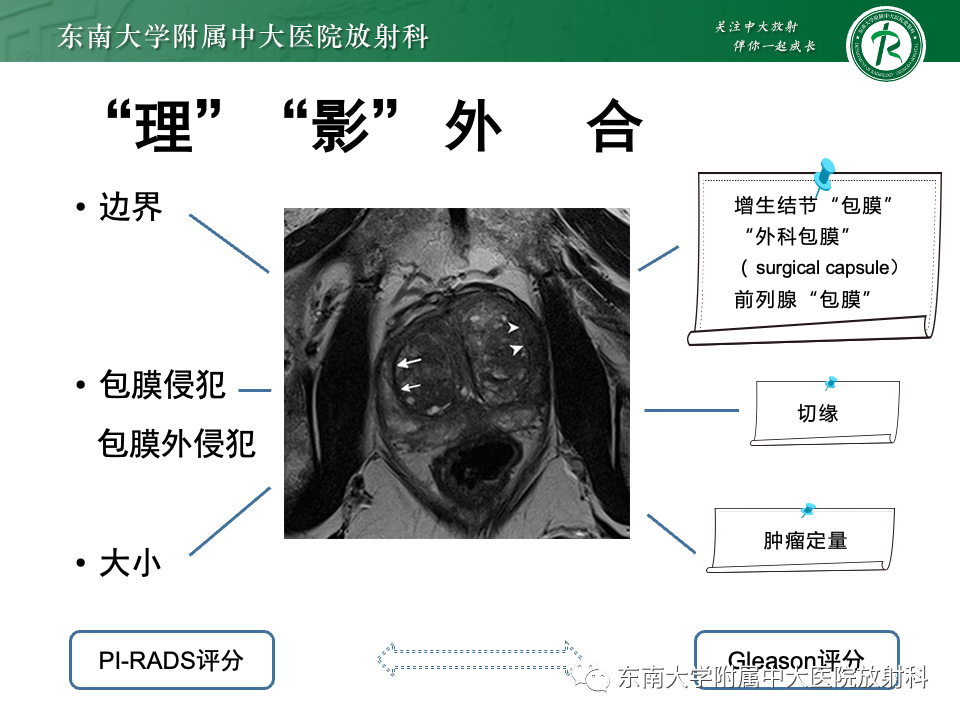 影像PPT - 【PPT】理影外合——前列腺癌-19 影像PPT - 【PPT】理影外合——前列腺癌-19