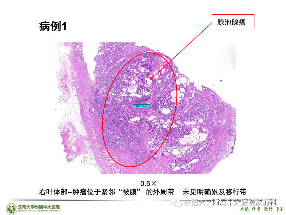 影像PPT - 【PPT】理影外合——前列腺癌-21 影像PPT - 【PPT】理影外合——前列腺癌-21