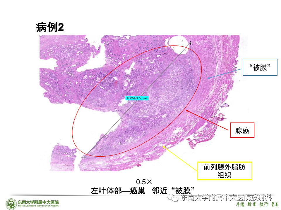 影像PPT - 【PPT】理影外合——前列腺癌-27 影像PPT - 【PPT】理影外合——前列腺癌-27