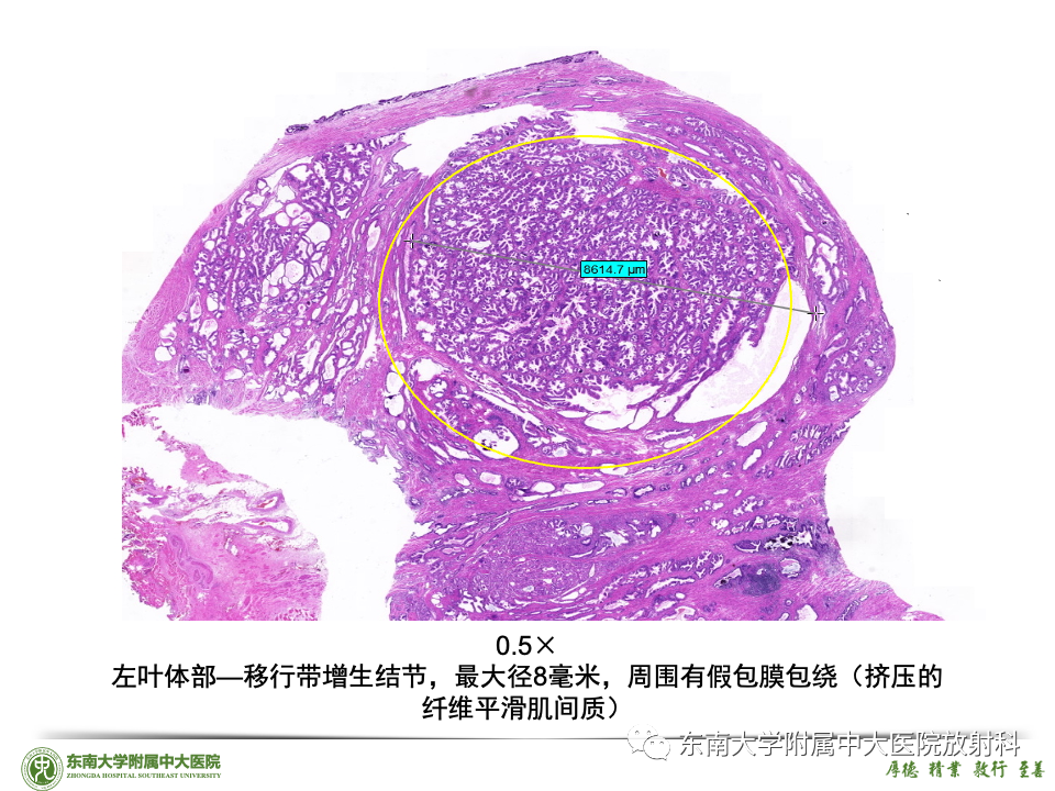 影像PPT - 【PPT】理影外合——前列腺癌-23 影像PPT - 【PPT】理影外合——前列腺癌-23