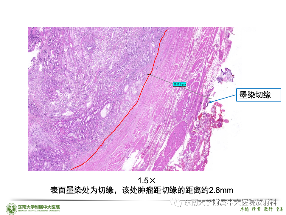 影像PPT - 【PPT】理影外合——前列腺癌-28 影像PPT - 【PPT】理影外合——前列腺癌-28