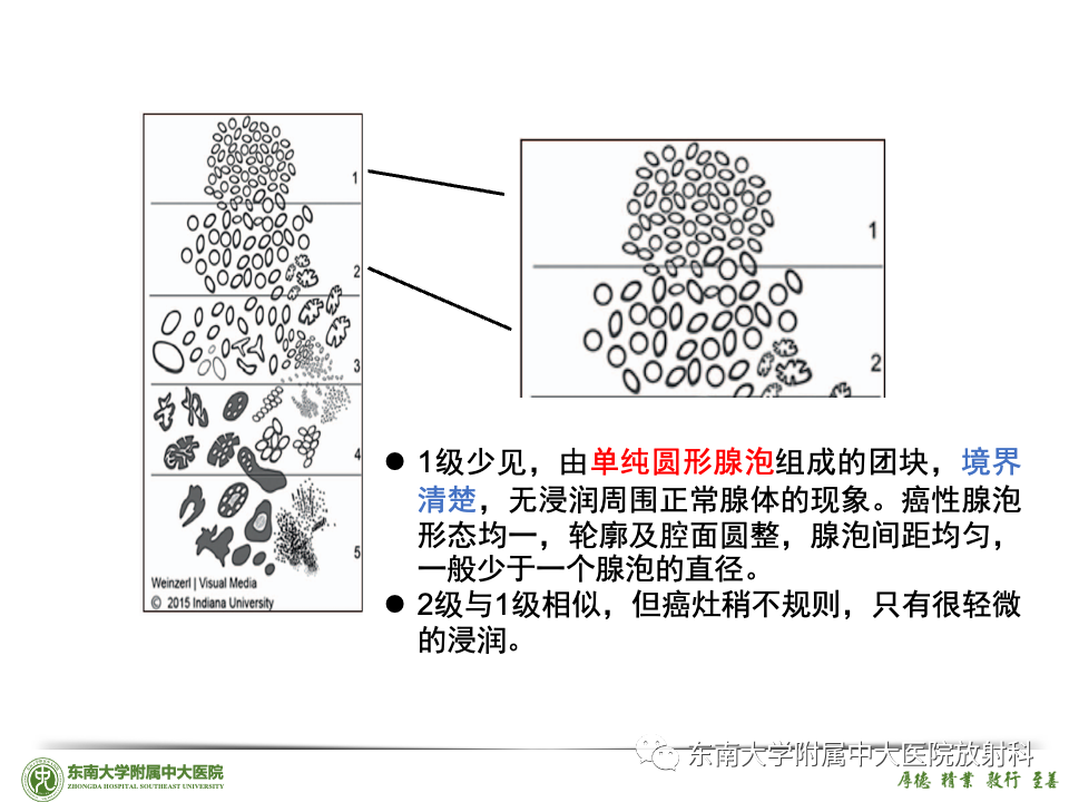 影像PPT - 【PPT】理影外合——前列腺癌-39 影像PPT - 【PPT】理影外合——前列腺癌-39