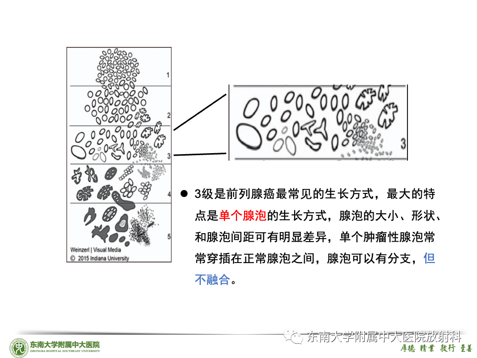 影像PPT - 【PPT】理影外合——前列腺癌-42 影像PPT - 【PPT】理影外合——前列腺癌-42