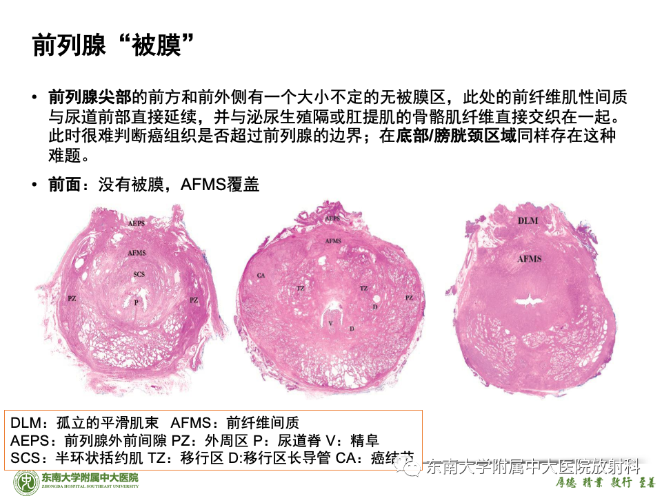 影像PPT - 【PPT】理影外合——前列腺癌-34 影像PPT - 【PPT】理影外合——前列腺癌-34