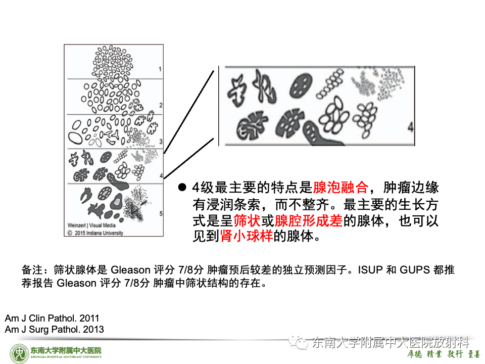 影像PPT - 【PPT】理影外合——前列腺癌-44 影像PPT - 【PPT】理影外合——前列腺癌-44