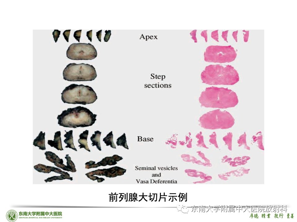 影像PPT - 【PPT】理影外合——前列腺癌-52 影像PPT - 【PPT】理影外合——前列腺癌-52