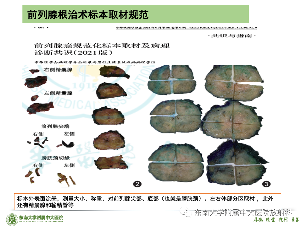 影像PPT - 【PPT】理影外合——前列腺癌-51 影像PPT - 【PPT】理影外合——前列腺癌-51