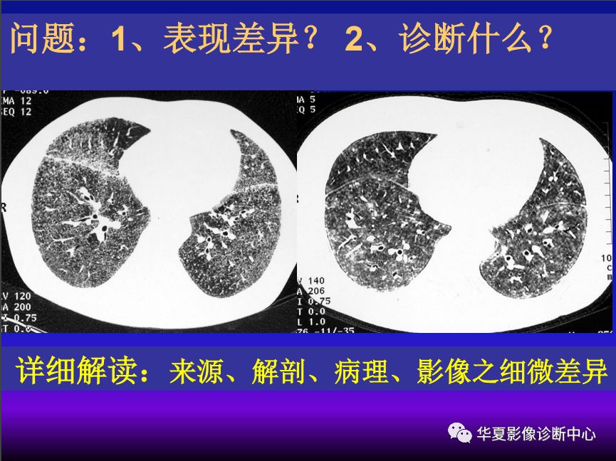 影像PPT - 【PPT】肺间质性疾病来源、解剖、病理和影像-4