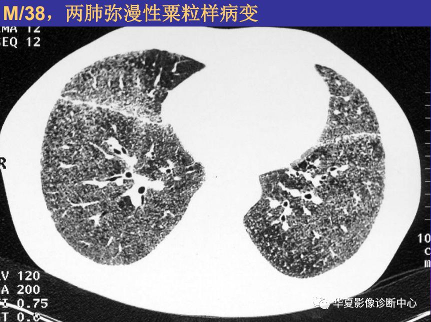 影像PPT - 【PPT】肺间质性疾病来源、解剖、病理和影像-2