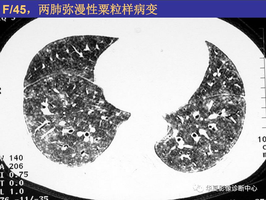 影像PPT - 【PPT】肺间质性疾病来源、解剖、病理和影像-3