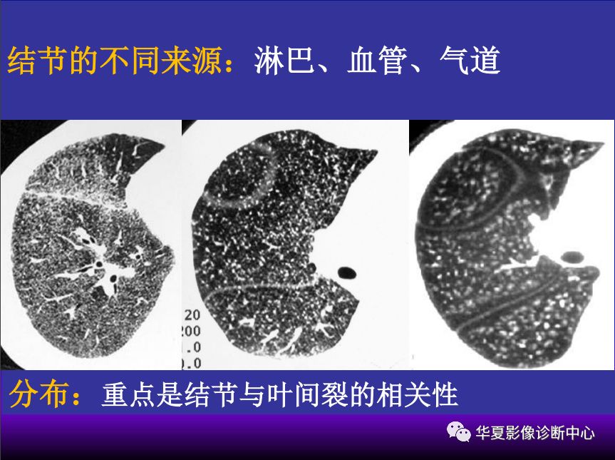 影像PPT - 【PPT】肺间质性疾病来源、解剖、病理和影像-9