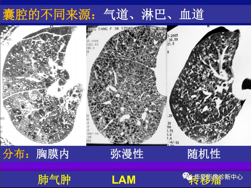 影像PPT - 【PPT】肺间质性疾病来源、解剖、病理和影像-11