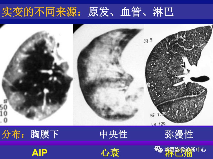 影像PPT - 【PPT】肺间质性疾病来源、解剖、病理和影像-10