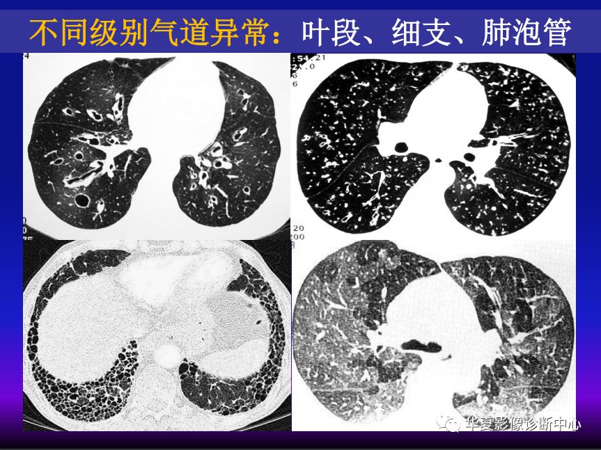 影像PPT - 【PPT】肺间质性疾病来源、解剖、病理和影像-20