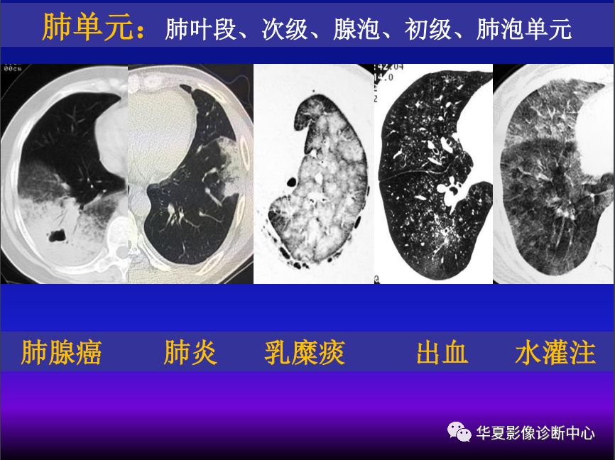 影像PPT - 【PPT】肺间质性疾病来源、解剖、病理和影像-21