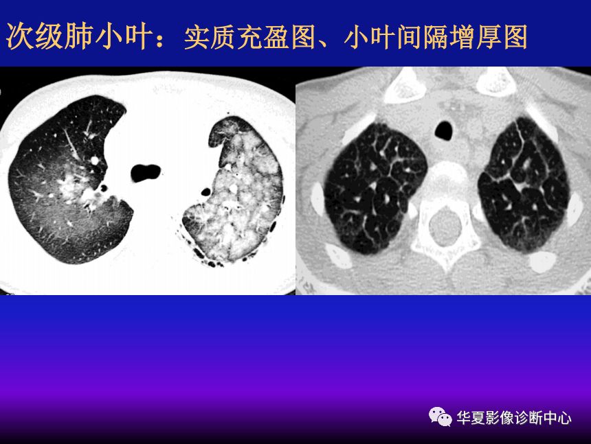 影像PPT - 【PPT】肺间质性疾病来源、解剖、病理和影像-22