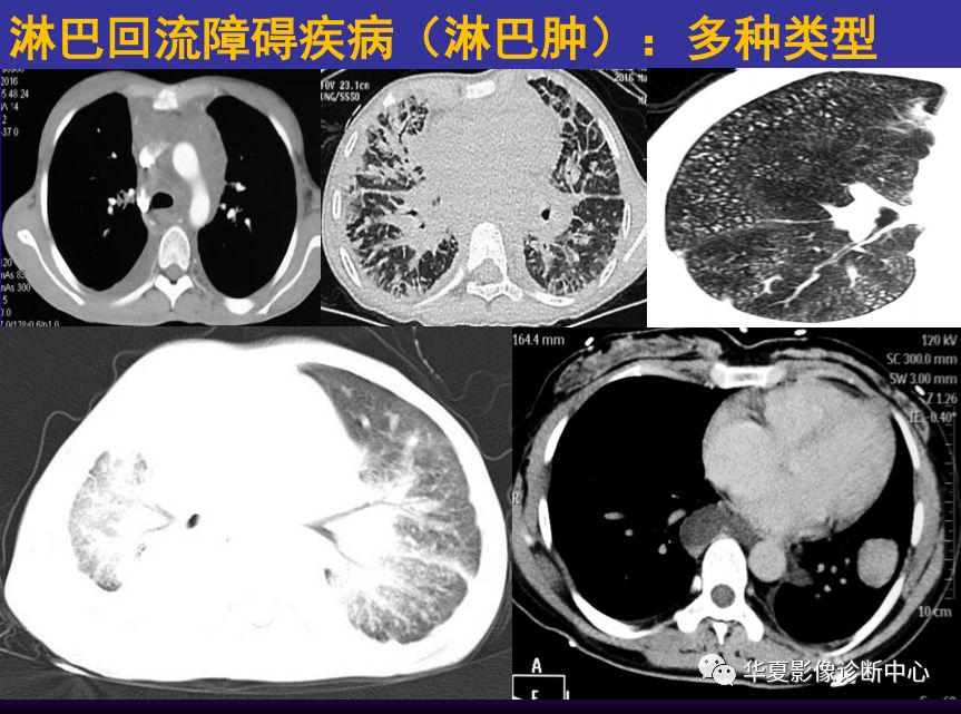 影像PPT - 【PPT】肺间质性疾病来源、解剖、病理和影像-28