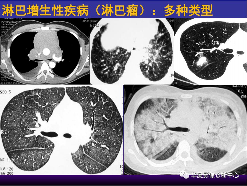影像PPT - 【PPT】肺间质性疾病来源、解剖、病理和影像-27