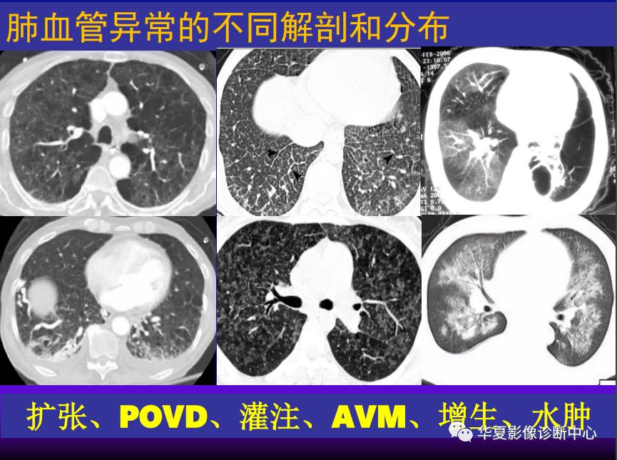 影像PPT - 【PPT】肺间质性疾病来源、解剖、病理和影像-31