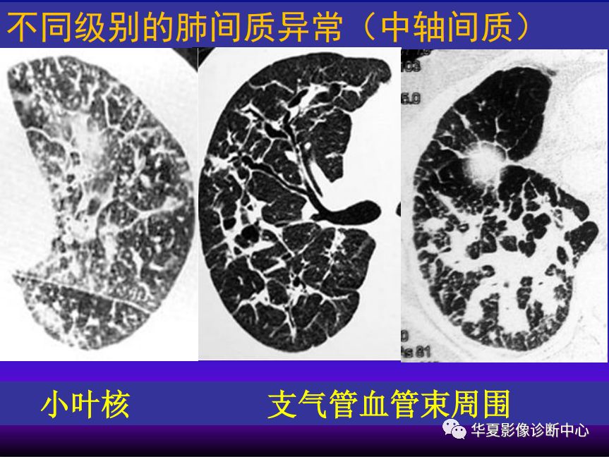 影像PPT - 【PPT】肺间质性疾病来源、解剖、病理和影像-36