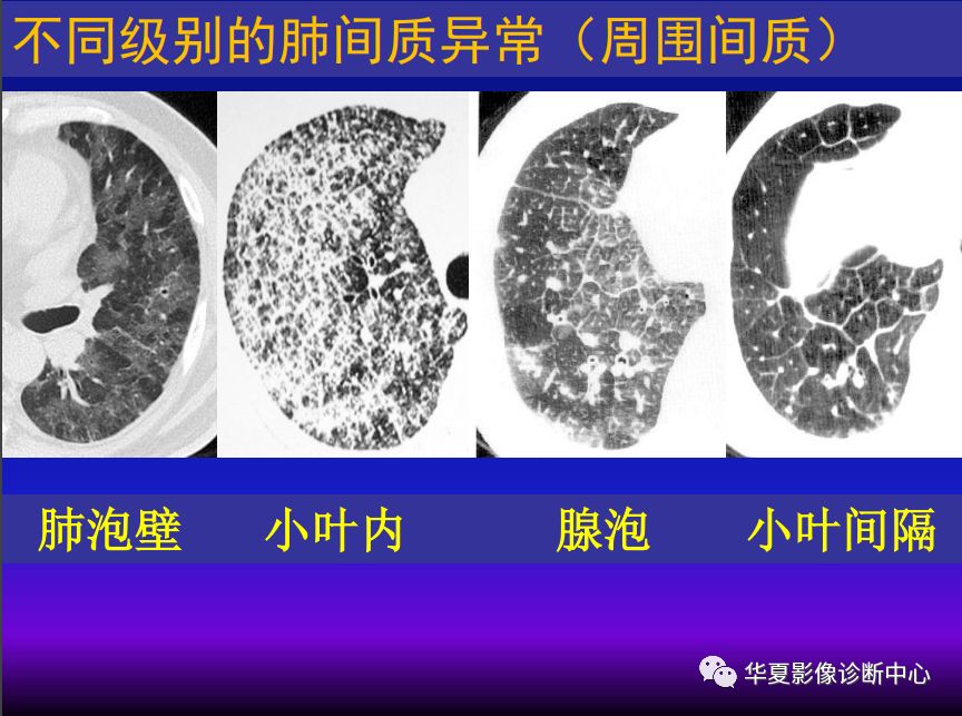 影像PPT - 【PPT】肺间质性疾病来源、解剖、病理和影像-35