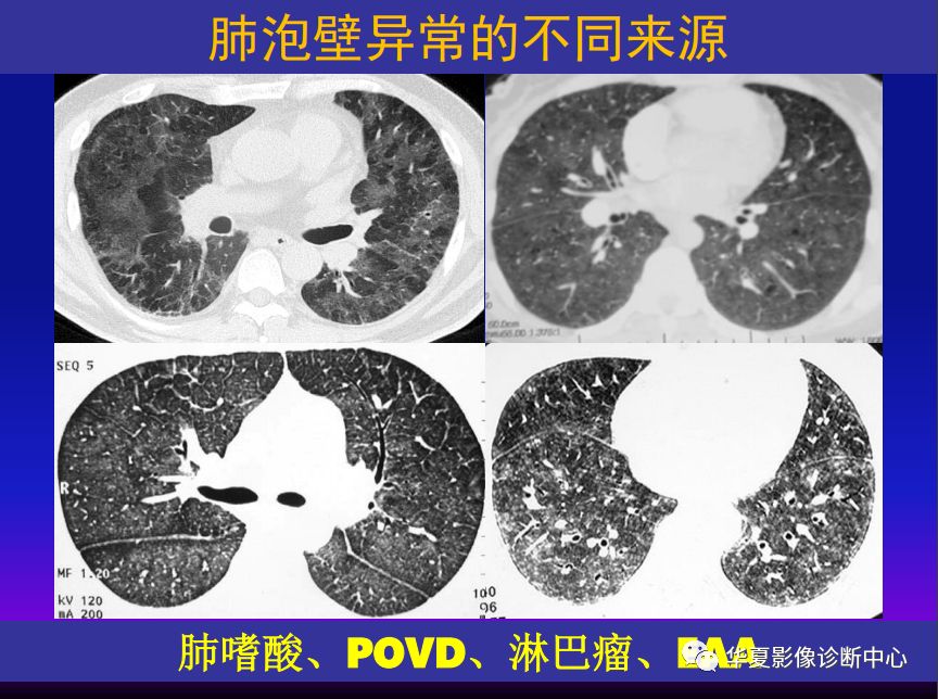 影像PPT - 【PPT】肺间质性疾病来源、解剖、病理和影像-37