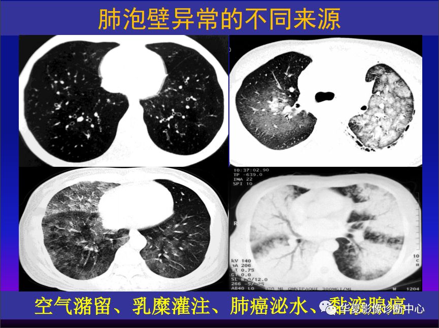 影像PPT - 【PPT】肺间质性疾病来源、解剖、病理和影像-41