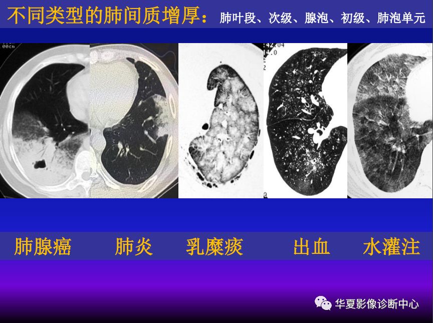 影像PPT - 【PPT】肺间质性疾病来源、解剖、病理和影像-42