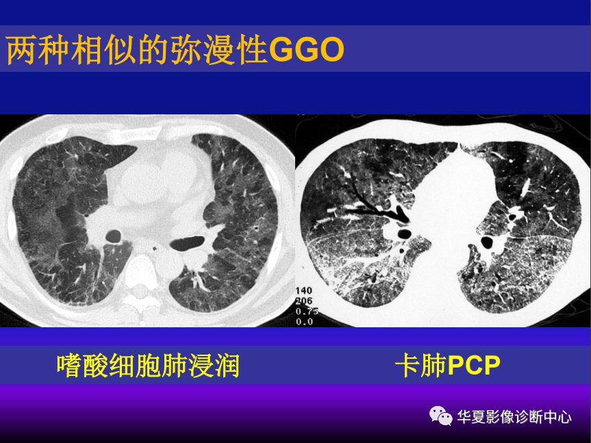 影像PPT - 【PPT】肺间质性疾病来源、解剖、病理和影像-47
