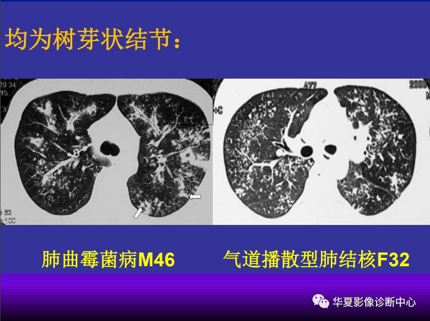 影像PPT - 【PPT】肺间质性疾病来源、解剖、病理和影像-49