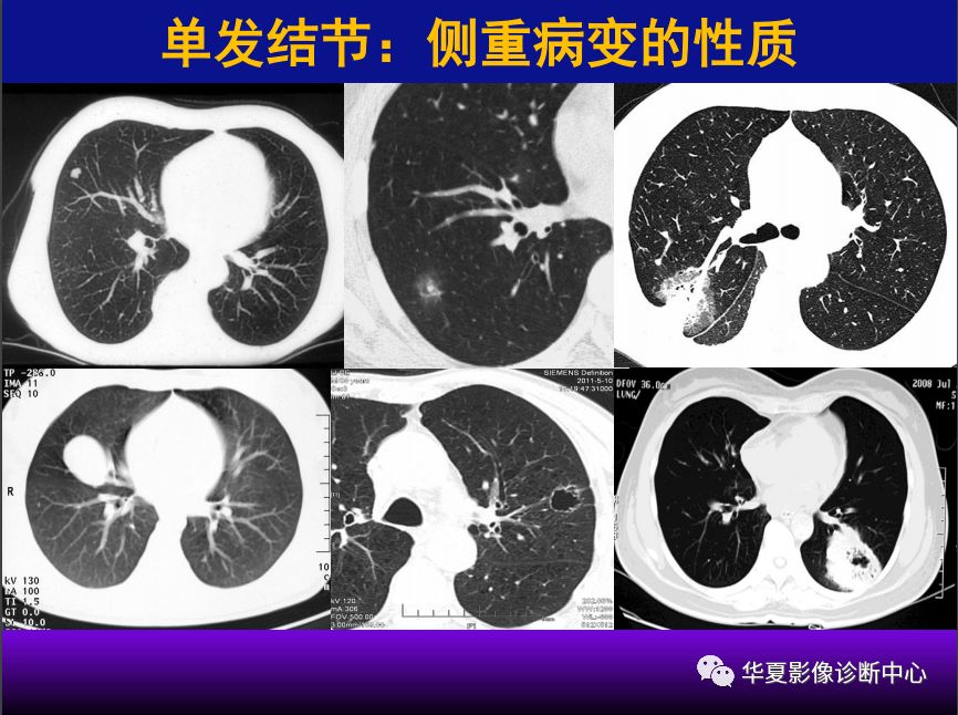 影像PPT - 【PPT】肺间质性疾病来源、解剖、病理和影像-51