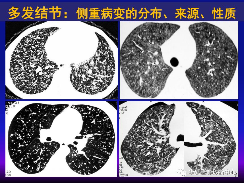 影像PPT - 【PPT】肺间质性疾病来源、解剖、病理和影像-52