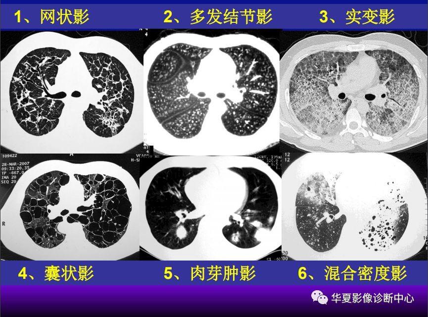 影像PPT - 【PPT】肺间质性疾病来源、解剖、病理和影像-54
