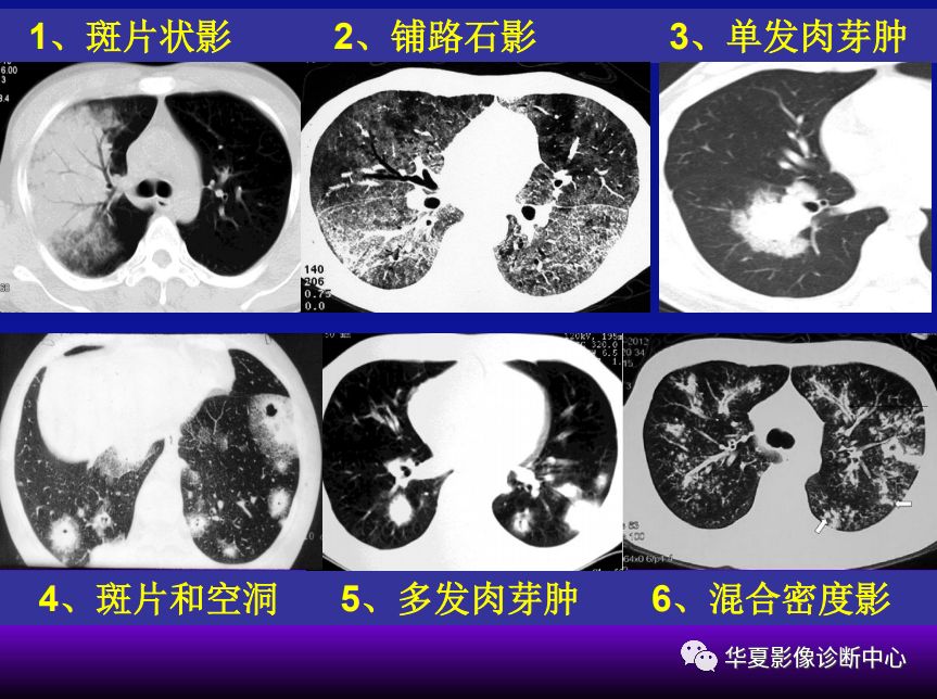 影像PPT - 【PPT】肺间质性疾病来源、解剖、病理和影像-57