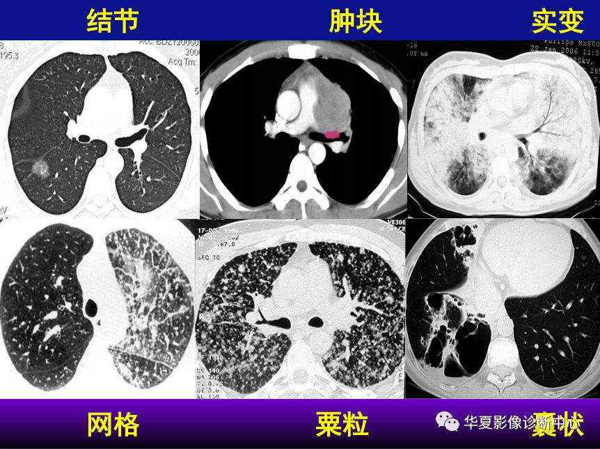 影像PPT - 【PPT】肺间质性疾病来源、解剖、病理和影像-56