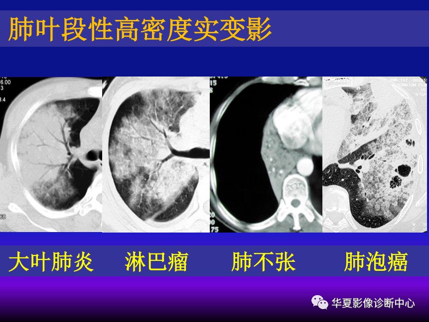 影像PPT - 【PPT】肺间质性疾病来源、解剖、病理和影像-58