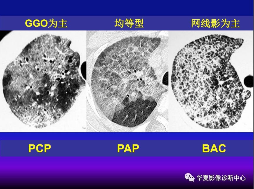 影像PPT - 【PPT】肺间质性疾病来源、解剖、病理和影像-60