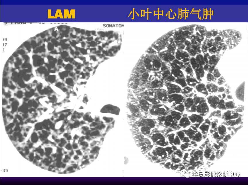 影像PPT - 【PPT】肺间质性疾病来源、解剖、病理和影像-61
