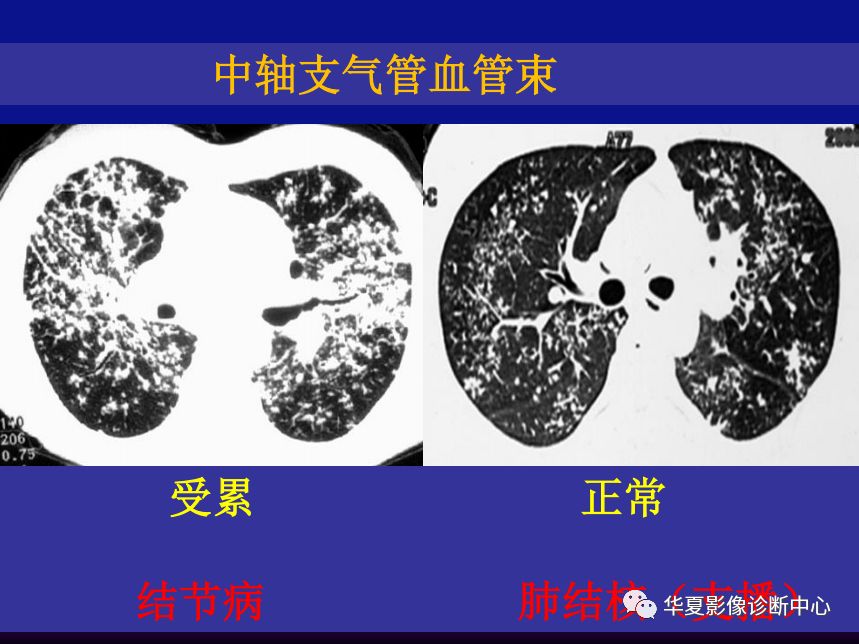 影像PPT - 【PPT】肺间质性疾病来源、解剖、病理和影像-62