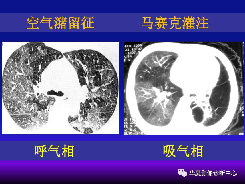 影像PPT - 【PPT】肺间质性疾病来源、解剖、病理和影像-63